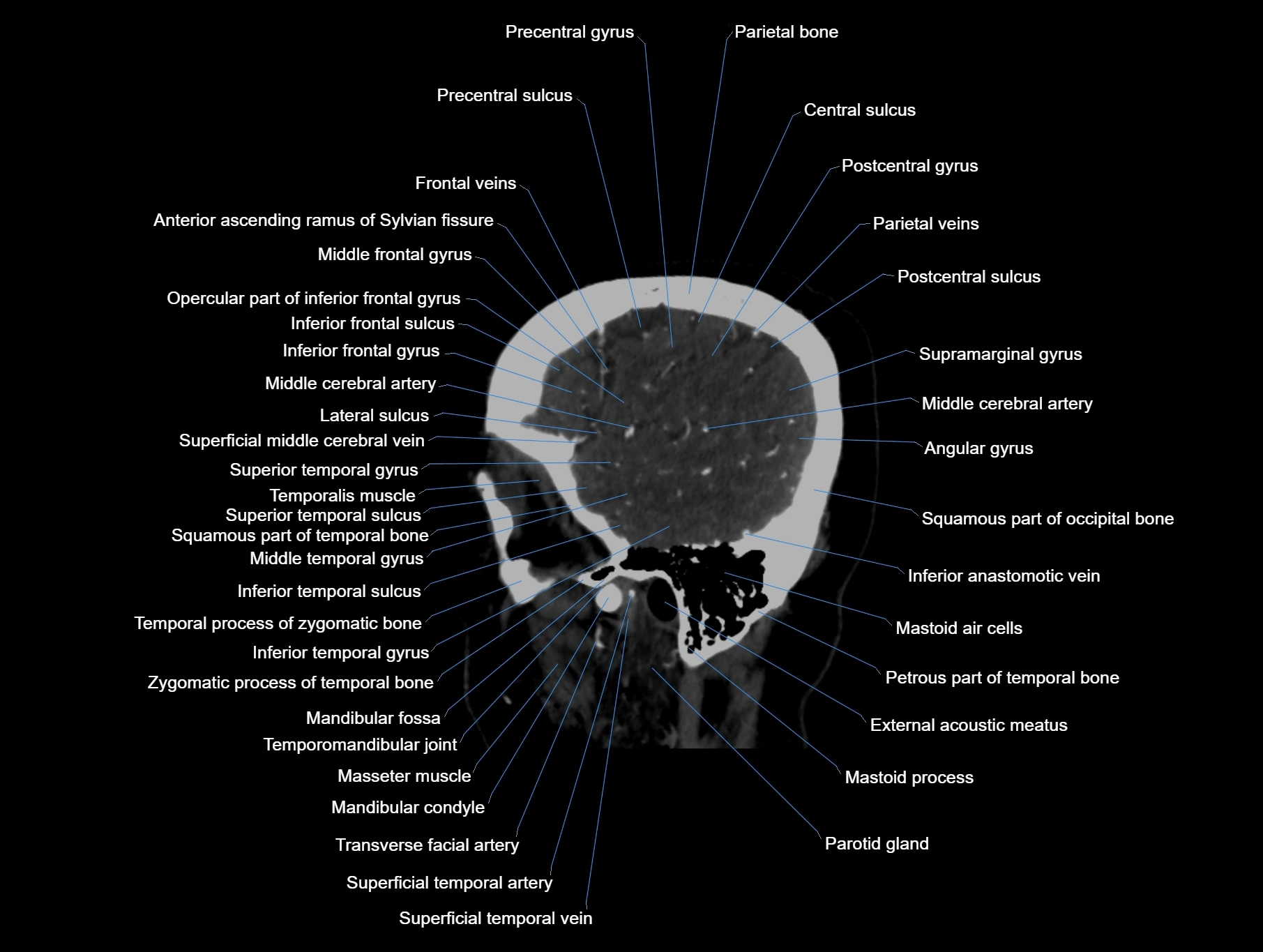 CT scan brain sagittal cross sectional anatomy image-img-00001-00012.webp